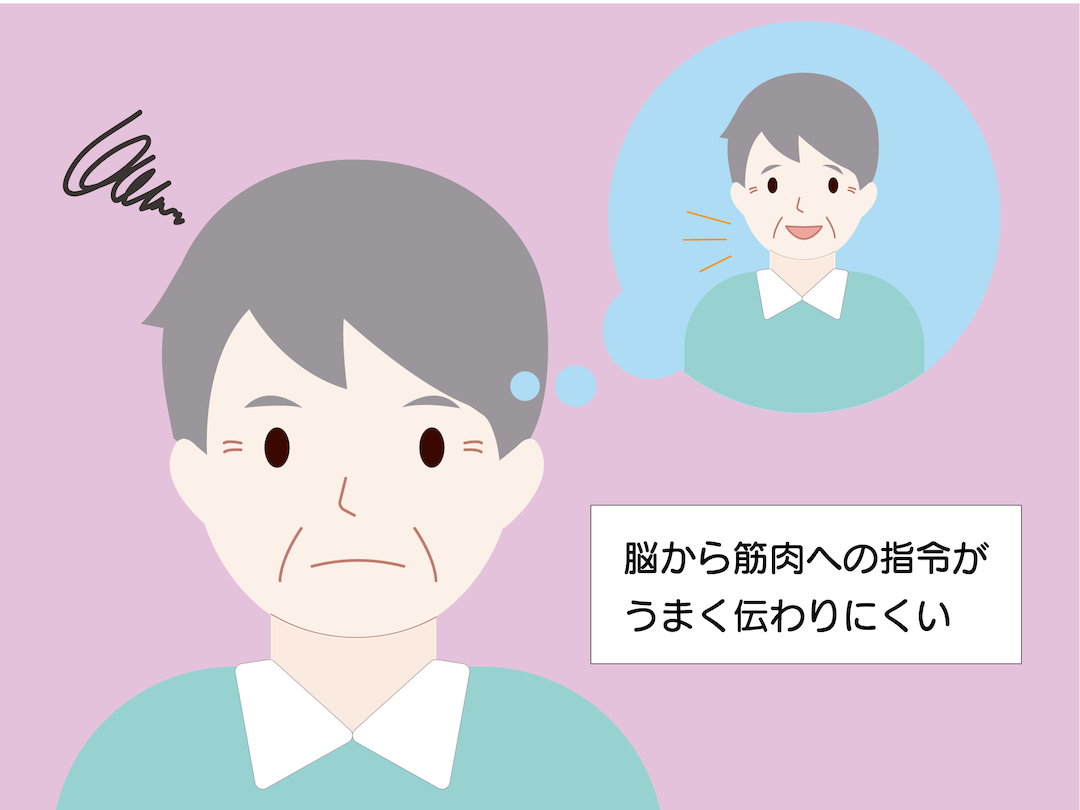 パーキンソン病に表情筋体操が大切な理由
