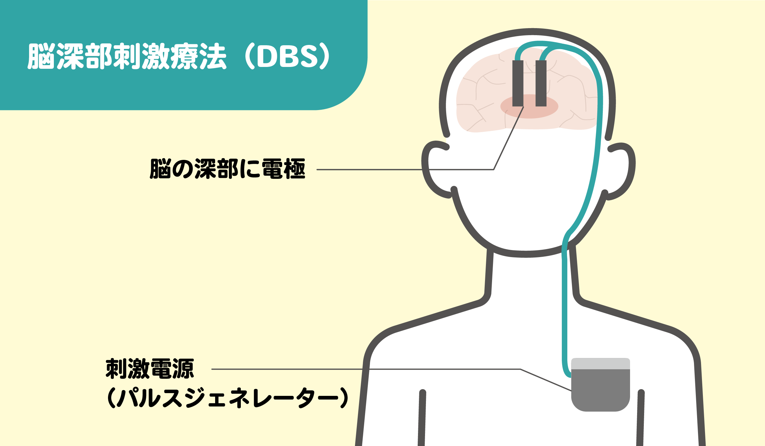 脳深部刺激療法(DBS)のしくみをわかりやすくイラストで図解