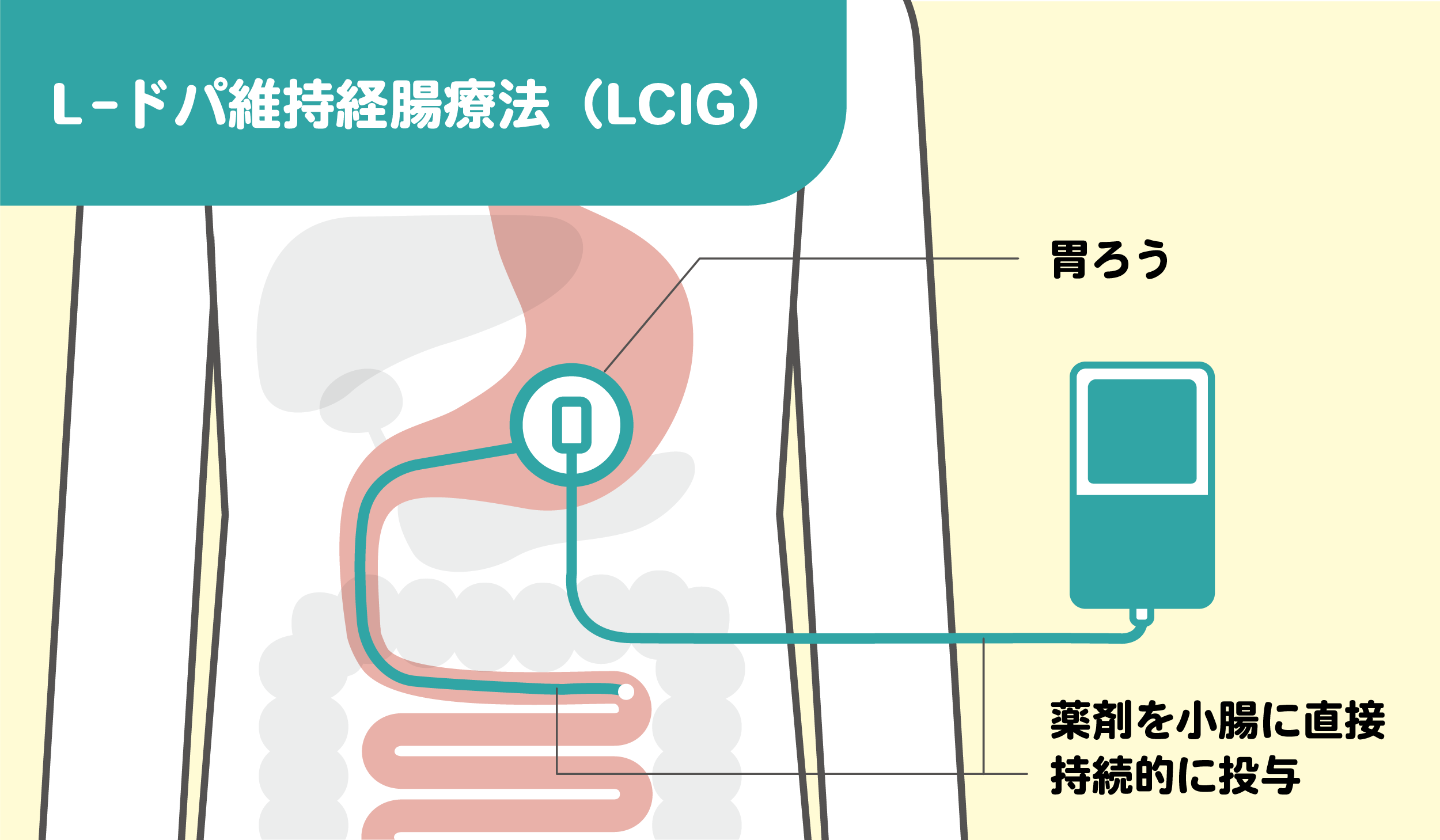 L-ドパ維持経腸療法(LCIG)のしくみをわかりやすくイラストで図解
