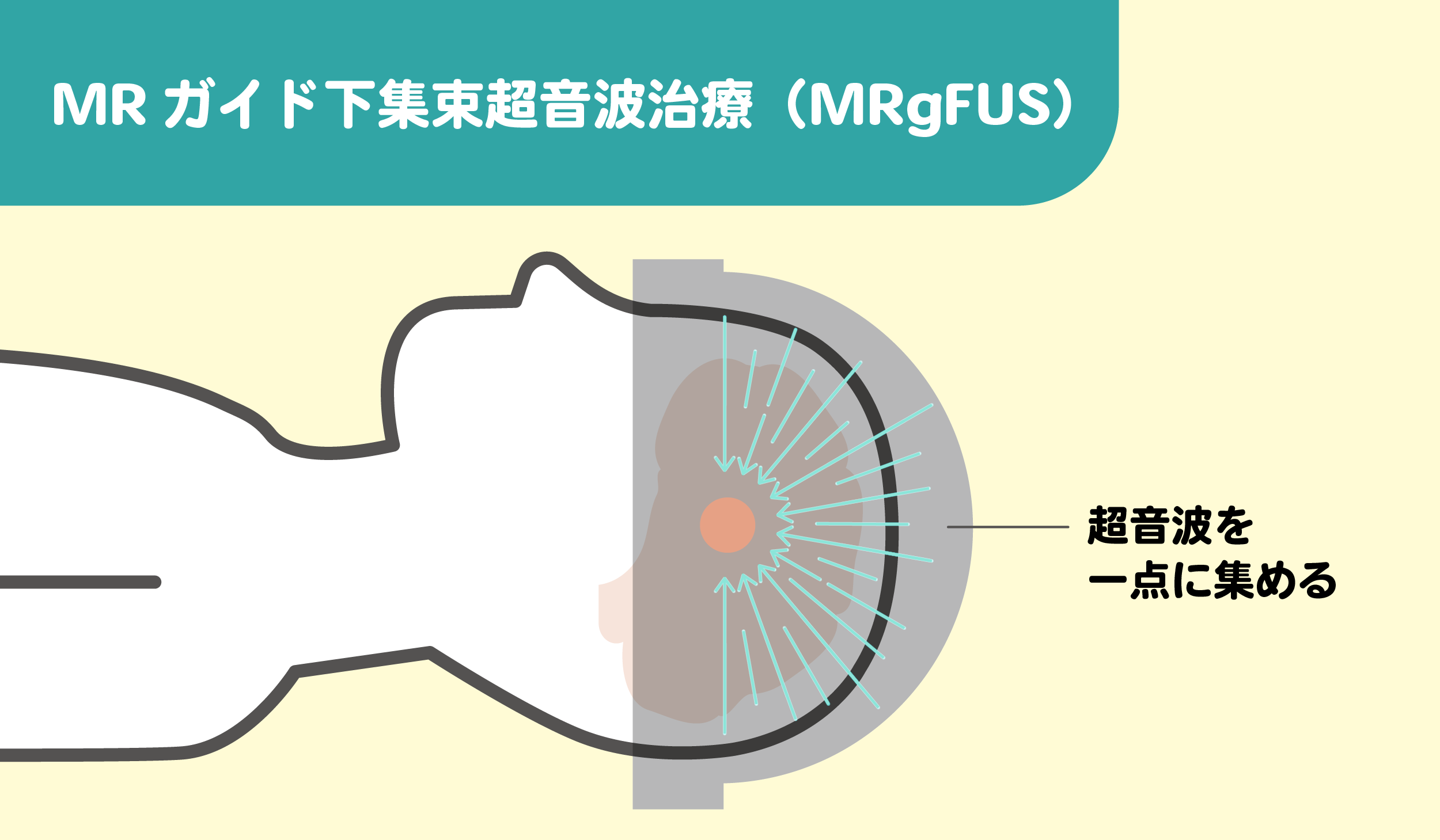 MRガイド下集束超音波治療(MRgFUS)のしくみをわかりやすくイラストで図解